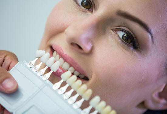 Dental Laminates