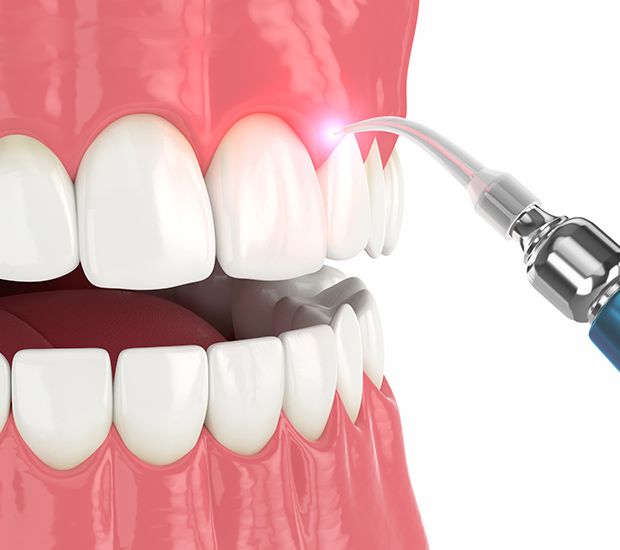 Gum Surgery