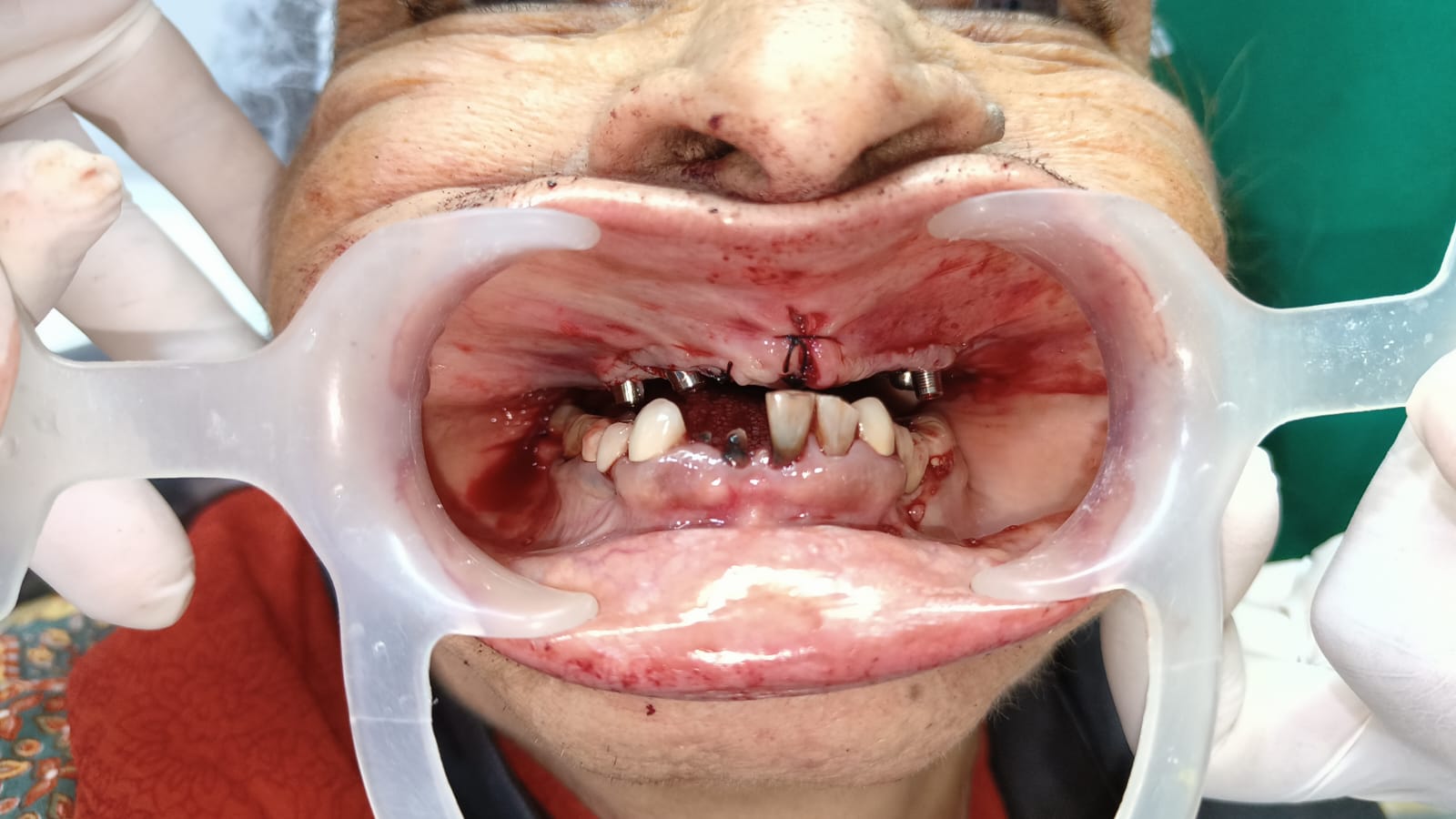 Braces in pune