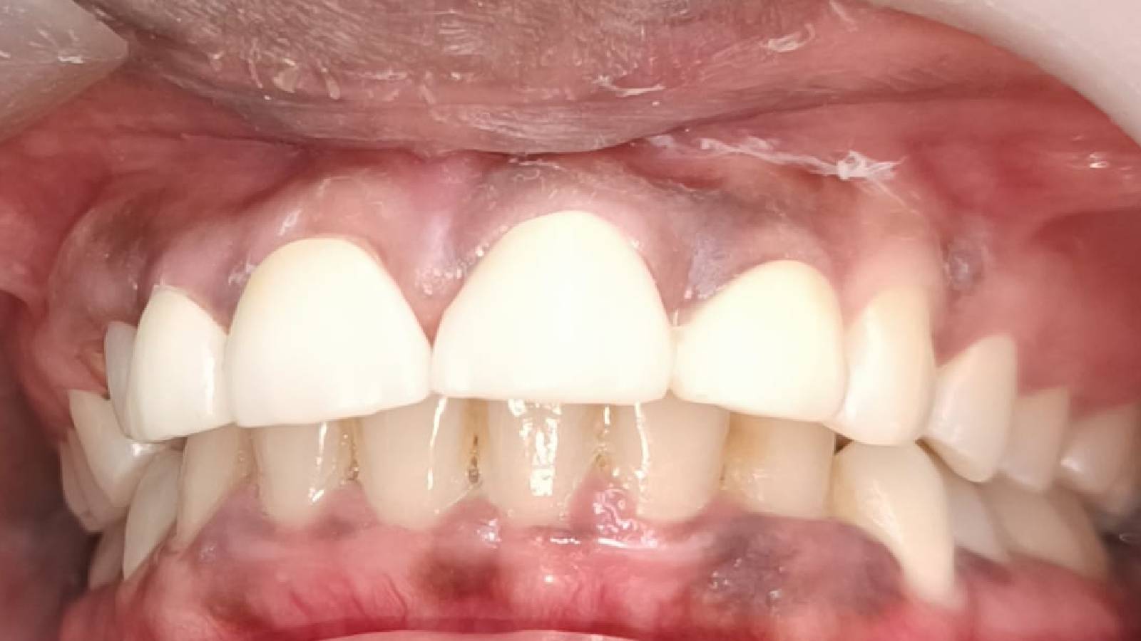 Root canal in pune
