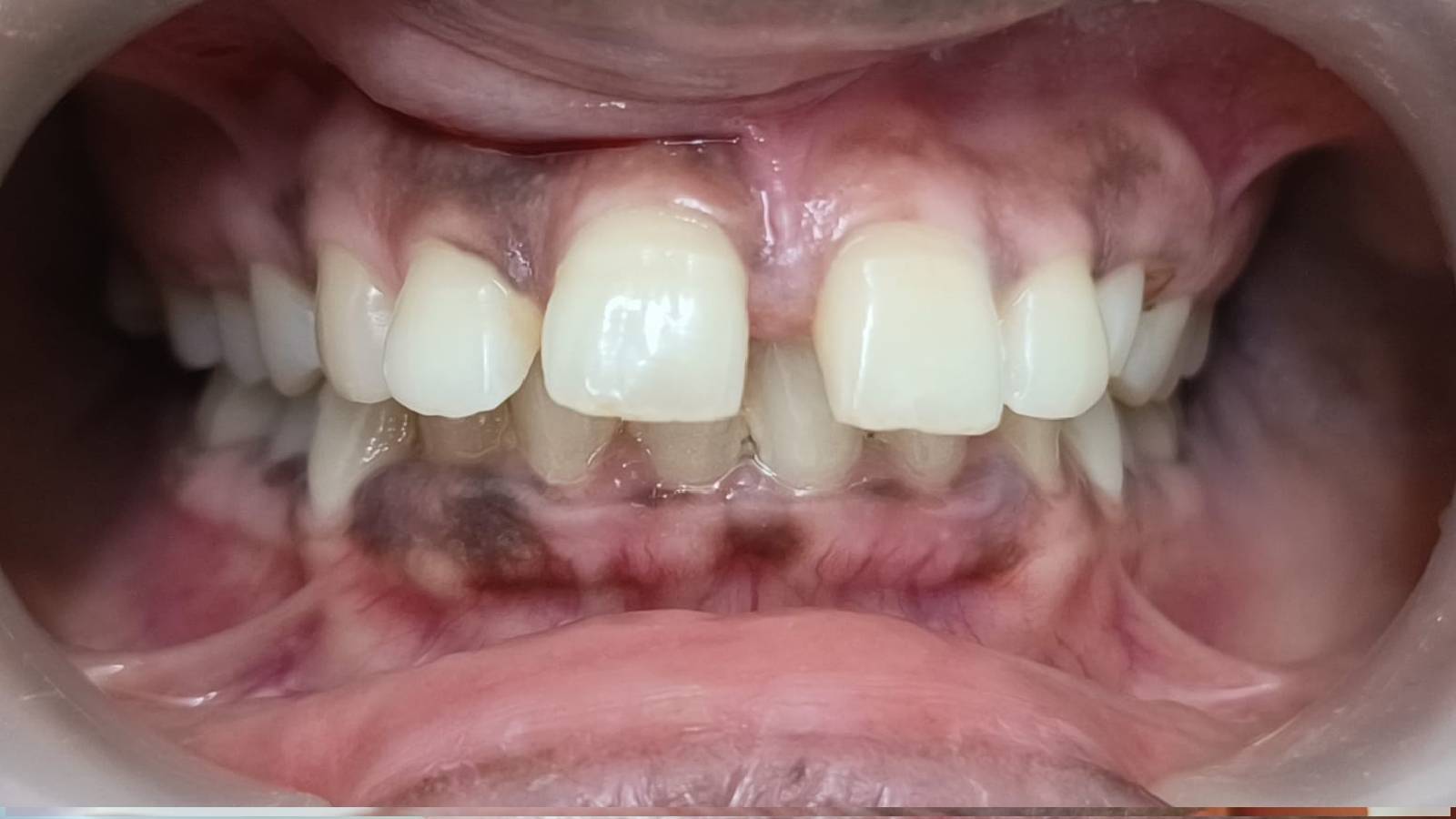 Braces in pune