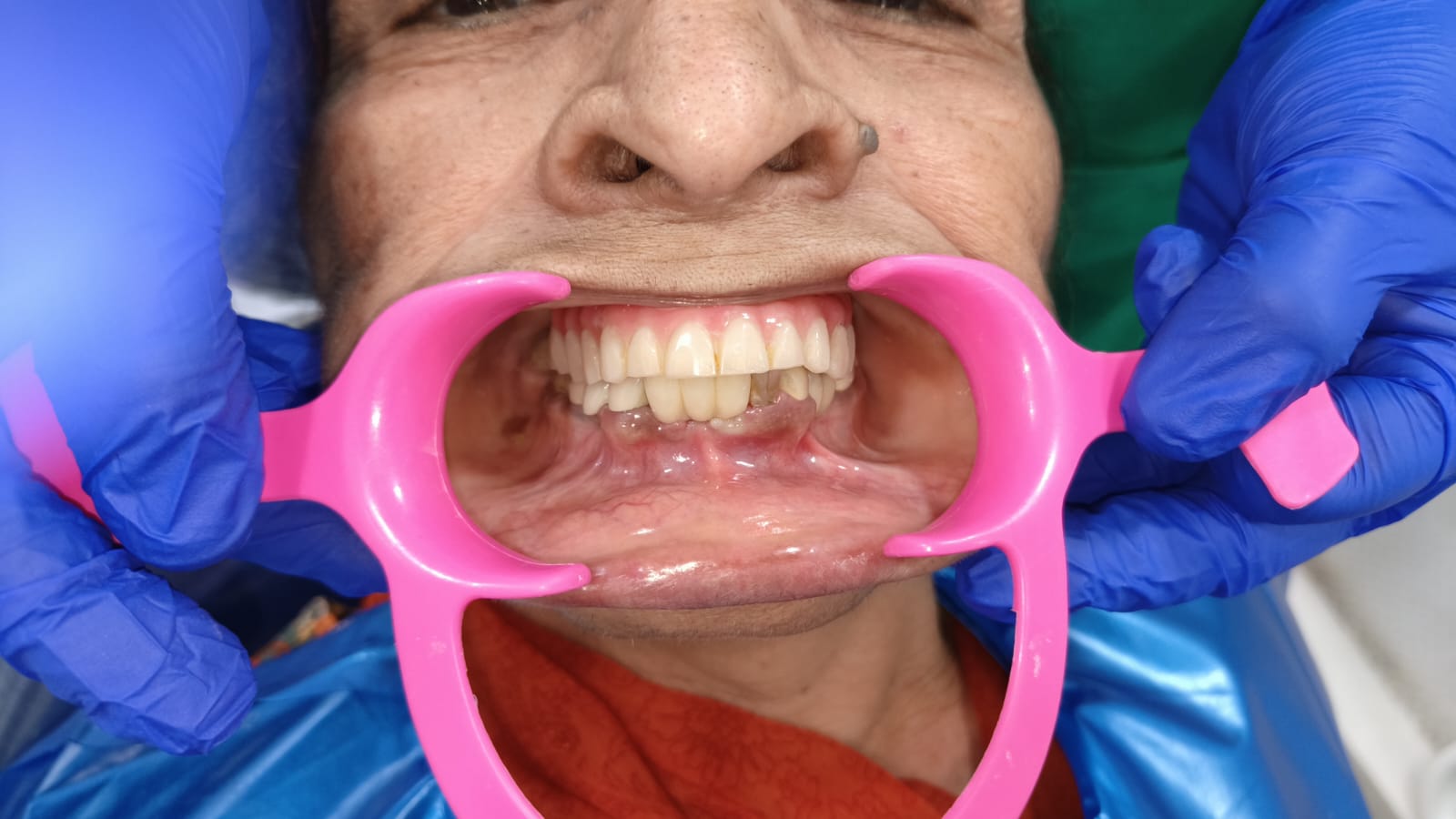 Root canal in pune